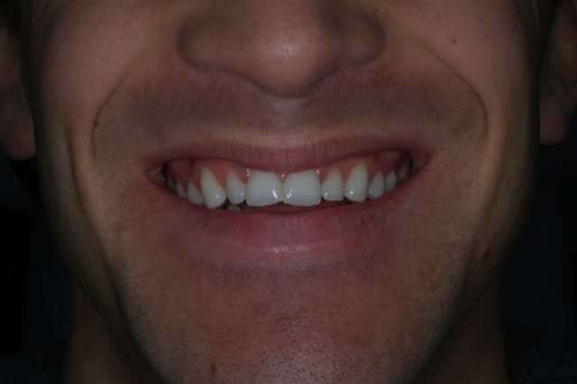 Non Prep Veneers-Hollywood Smile made in Germany!